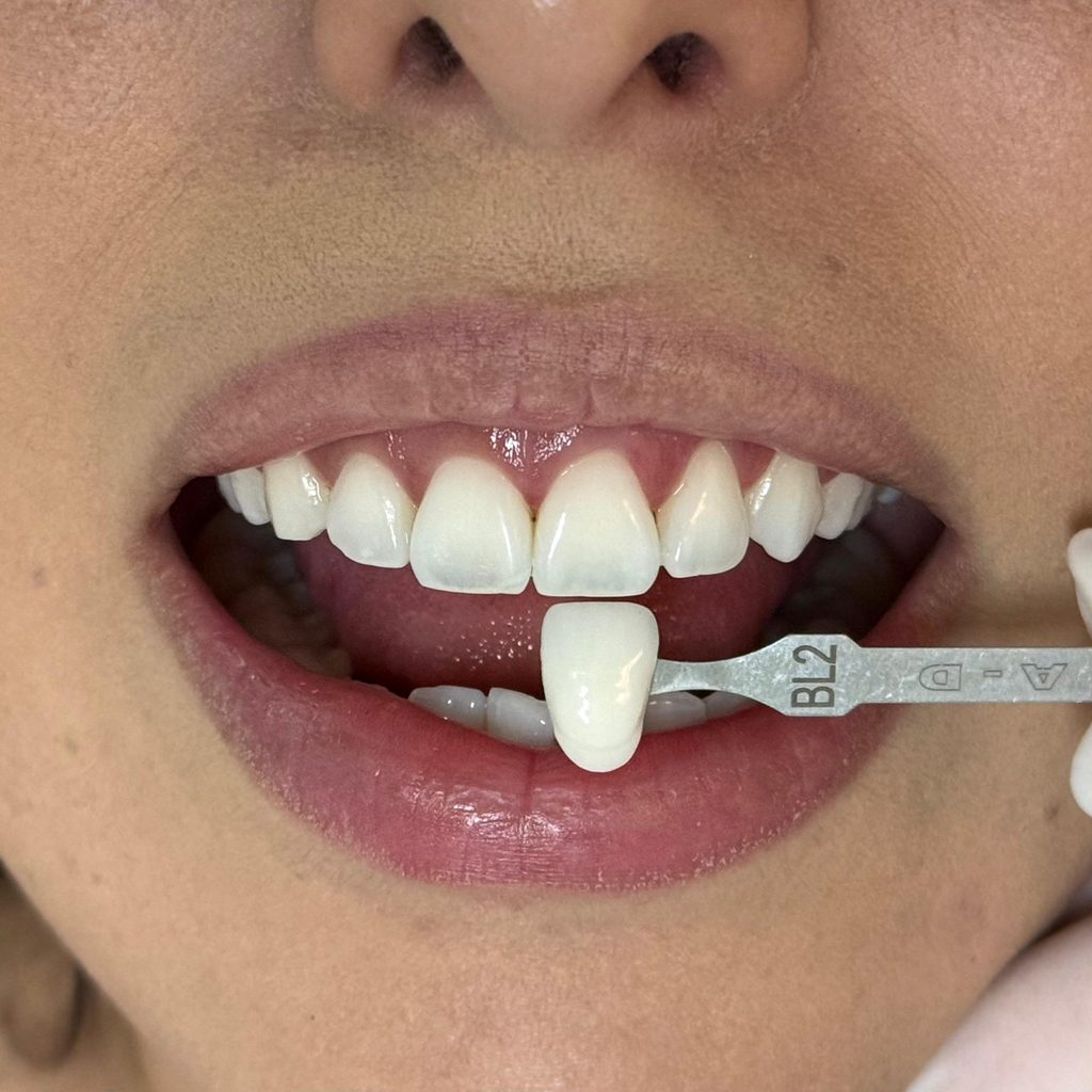 Escala de cor de dentes após clareamento, cor BL2
