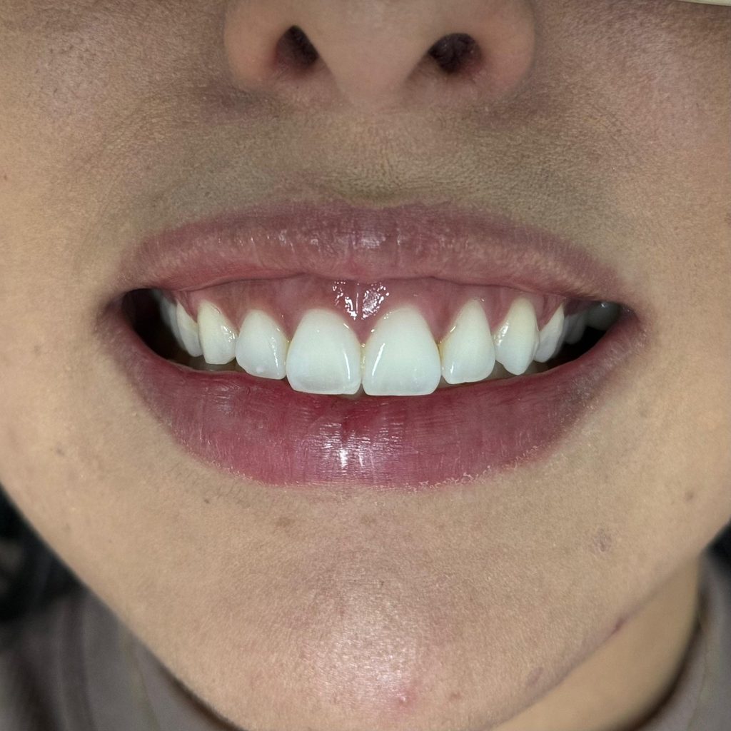 Sorriso antes do tratamento