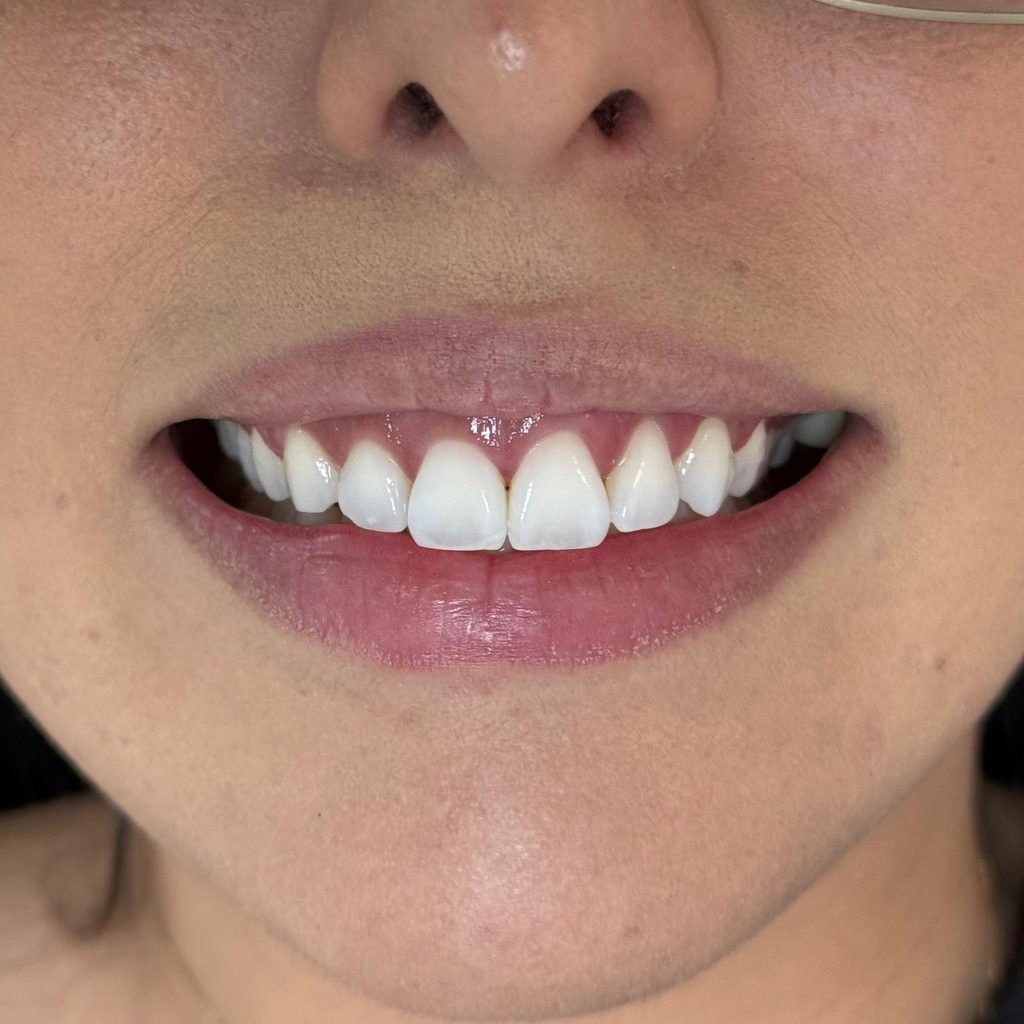 Sorriso após o tratamento clareador